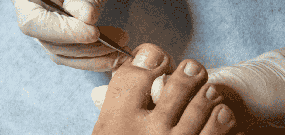 Ingrown toenail surgery — nail avulsion under local anaesthetic